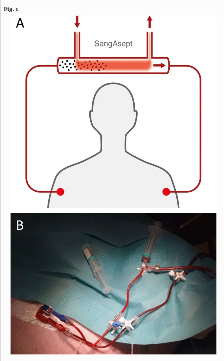 ICMexperimental's tweet image. Did you miss our last paper about the bactericide role of Ozone in human blood? 🦠‼️

Read more about this #experimentalmodel of a novel system of extracorporeal ozone blood treatment!

icm-experimental.springeropen.com/articles/10.11…

#intensivecare #research #sepsis #ecoli #extracorporeal
