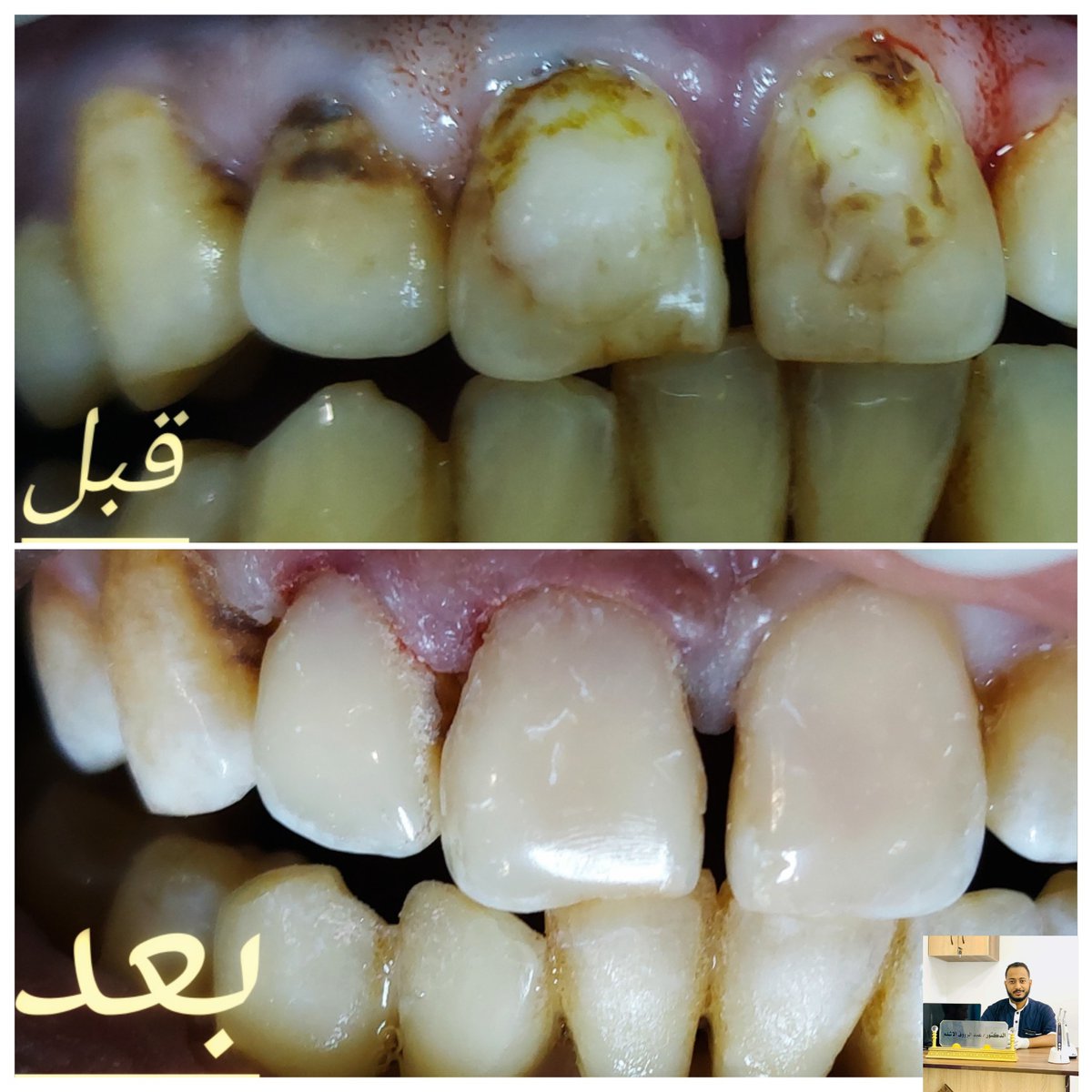 RLashalm's tweet photo. مريض يشكو من تصبغ الاسنان وتصبغ الحشوه القديمه.....
تم عمل قشور ضوئيه مباشره باستخدام النوع العالمي Palfique Asteria ..في جلسه واحده .. https://t.co/p6ee6q8UFB