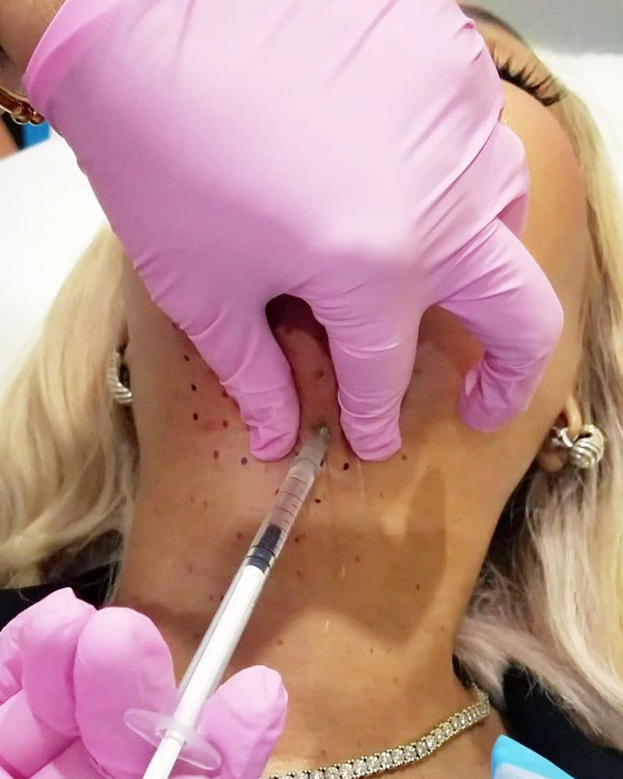 AmerejuveMedSpa's tweet photo. 🔥SAY GOODBYE DOUBLE CHIN WITH KYBELLA
#kybella #doublechin #plasticsurgery #injectables #jawline #skintightening #botoxandfillers #botox #fillers #medspa #houstonmedspa #atlantamedspa https://t.co/rA1nUAPCiE
