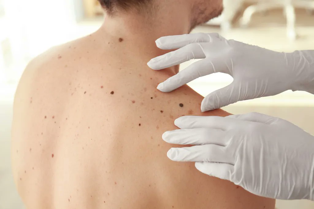 VanguardDermNY's tweet photo. Have you noticed a change in the shape, size, or color of your moles? Having them examined frequently is a great way to help detect an issue and treat it before it becomes a problem. Your doctor will explain what type of abnormalities they are looking for. https://t.co/B2gDwWisLE https://t.co/0lnAxn4wqA