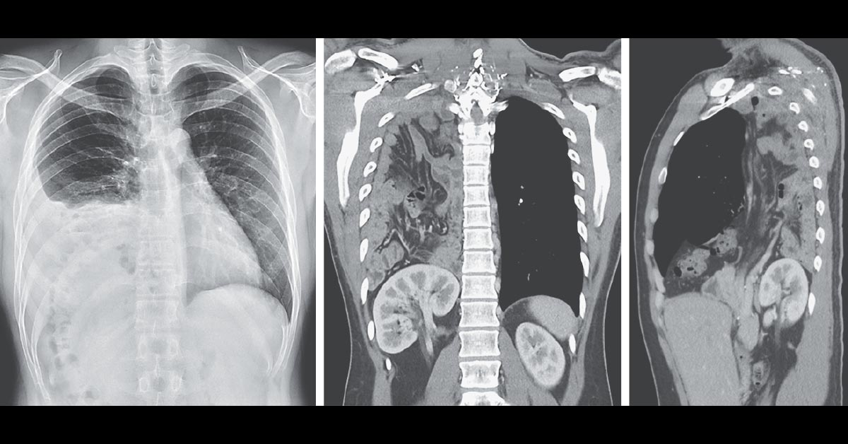 NEJM's tweet photo. An asymptomatic 25-year-old man presented to the emergency department with abnormal results on a preemployment chest radiograph. https://t.co/SIkofg5Jxu https://t.co/RQdX5ak9bb