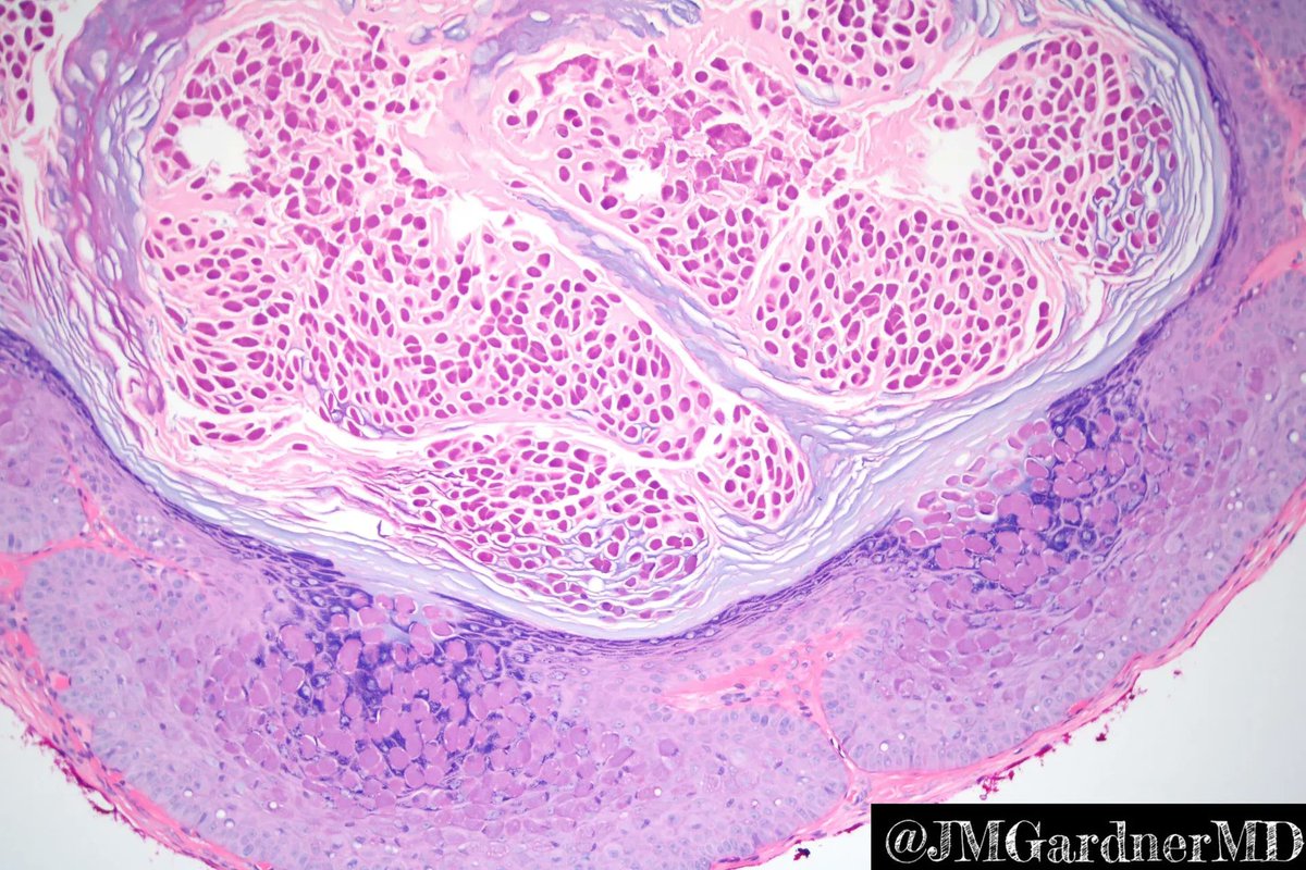 JMGardnerMD's tweet photo. Cyst from the thigh of a child. Your diagnosis? Answer here: https://t.co/r5IAsJEEhl. #pathology #pathologists #pathTwitter #dermpath #dermatology #dermatologia #dermtwitter https://t.co/4VQxXFrdls