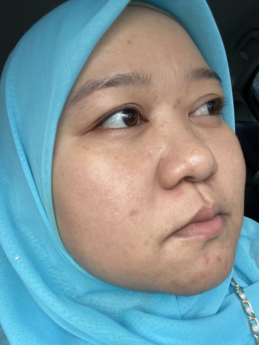 adahunnylove's tweet photo. Aku splurge big amount of money beli Dr’s Secret skincare. Lepas tengok @LilyBrahim transformation. Hope menjadi laaa.. my skin condition right now. https://t.co/LfsrPzYmdu