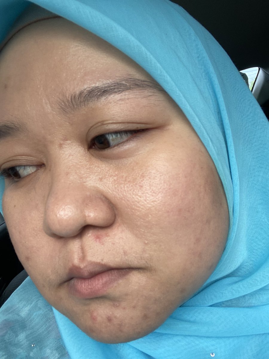 adahunnylove's tweet photo. Aku splurge big amount of money beli Dr’s Secret skincare. Lepas tengok @LilyBrahim transformation. Hope menjadi laaa.. my skin condition right now. https://t.co/LfsrPzYmdu