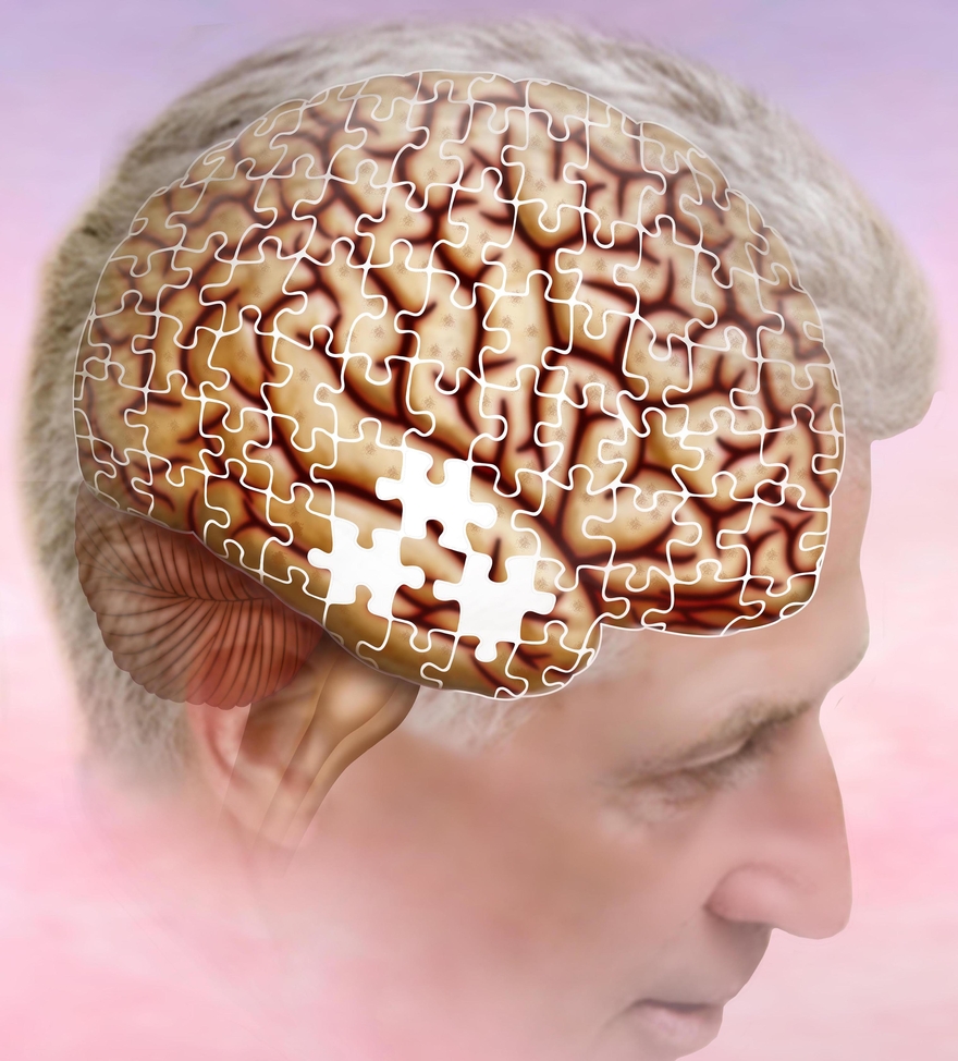 Pharmacy_Times's tweet photo. Exercise can play a role in maintaining body mass index (BMI) and insulin levels and protect brain volume, which may help prevent dementia, according to the results of a new study published in @GreenJournal.

Read More: https://t.co/A9rb9mEQ5Z https://t.co/UvlzRzJDdl