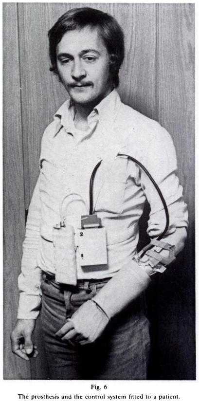 EricJEarley's tweet photo. Please take a moment to appreciate this state-of-the-art, 3 degree-of-freedom multifunctional #prosthetic hand from 1978 🦾
#Bionics #BionicLimbs https://t.co/3xcMZqDHVW