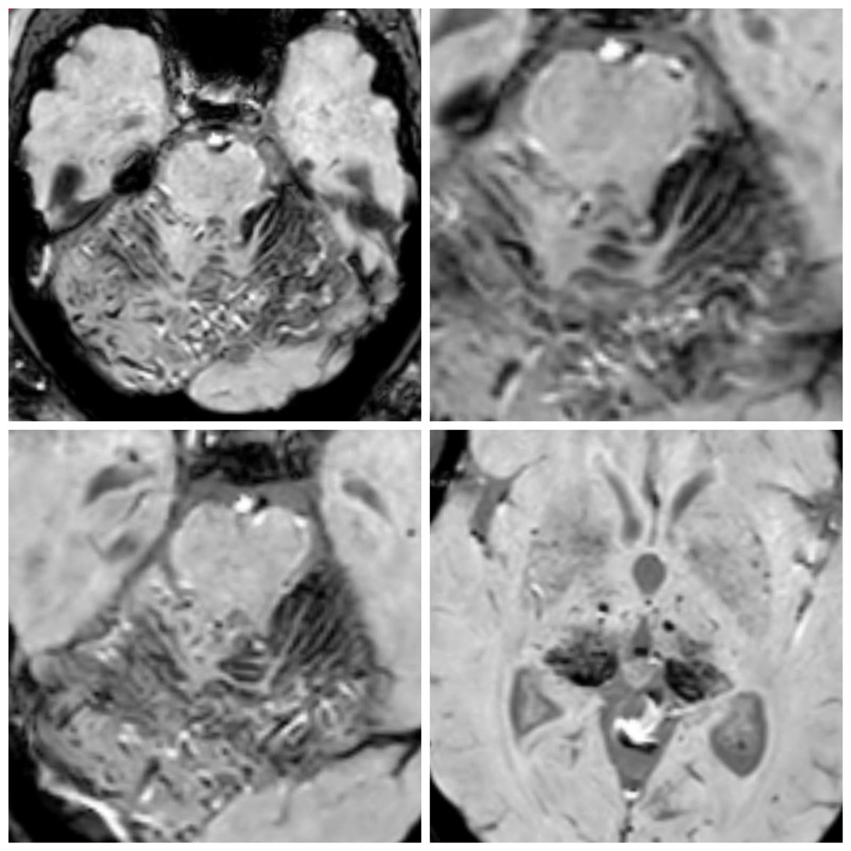 SharathKumarGG7's tweet photo. Curative embolisation of VOG DAVF presenting with superficial siderosis and thalamic dementia! @ApolloInter
#superficialSiderosis #embolisation #MedTwitter #neurotwitter #endovascular #INR #duralavf #fistula #neurorad #neuroscience #0nyx #MMA #Dementia https://t.co/YYXL9zgbTK