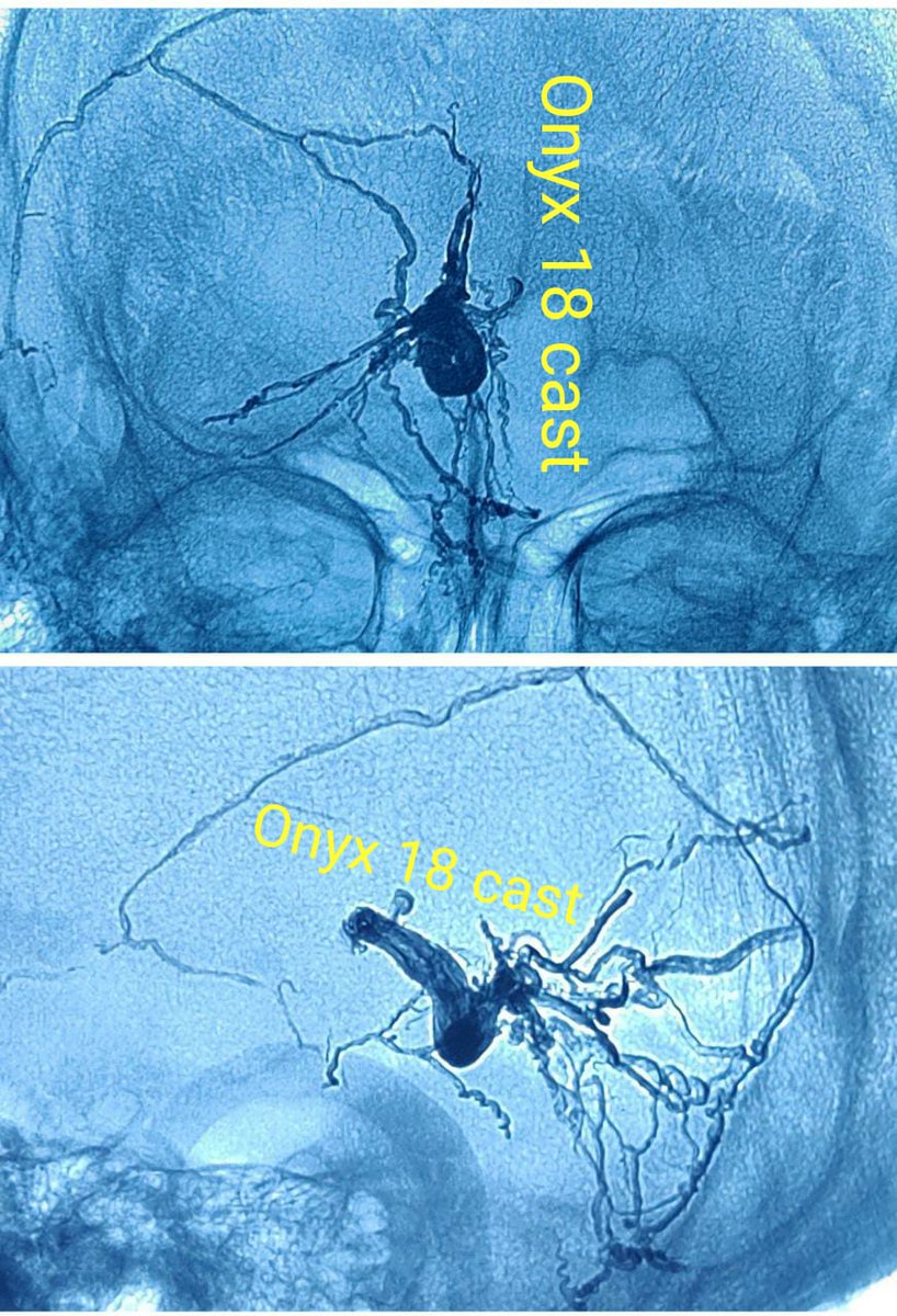 SharathKumarGG7's tweet photo. Curative embolisation of VOG DAVF presenting with superficial siderosis and thalamic dementia! @ApolloInter
#superficialSiderosis #embolisation #MedTwitter #neurotwitter #endovascular #INR #duralavf #fistula #neurorad #neuroscience #0nyx #MMA #Dementia https://t.co/YYXL9zgbTK