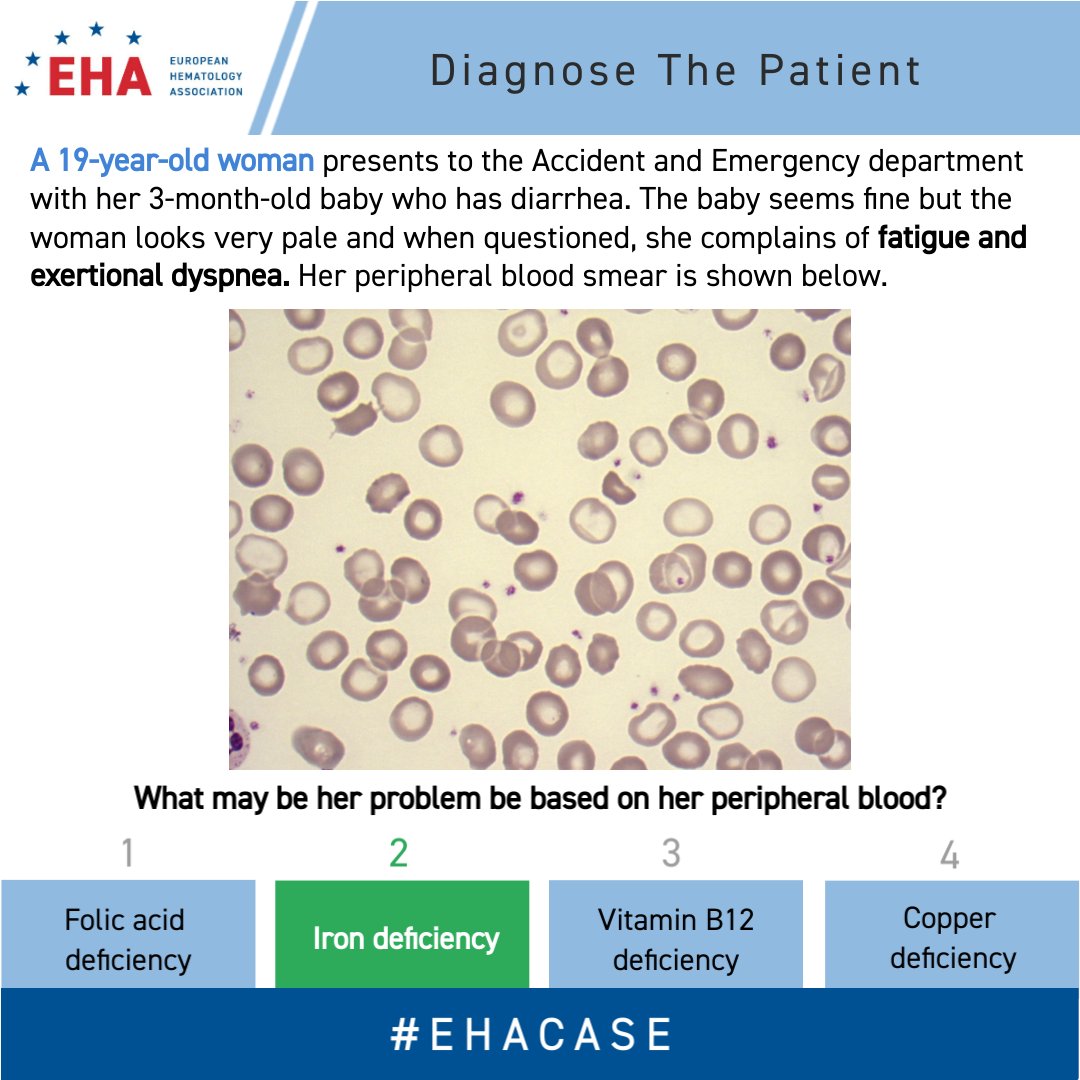 Thank you for taking a look at our patient. Were you able to figure out the cause of her ailments? 👇 See below to find out if you've gotten it right.👋 We'll catch you again in the morning with a detailed explanation. #EHACase