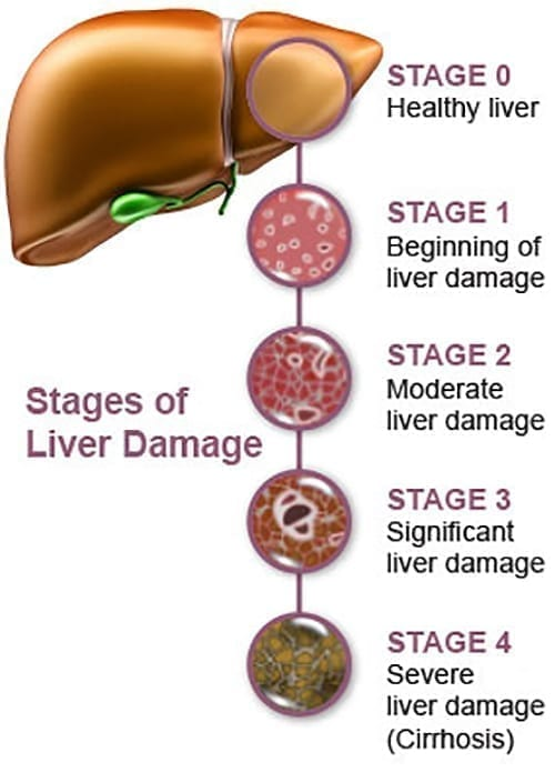 Over time liver disease can cause 𝗖𝗜𝗥𝗥𝗛𝗢𝗦𝗜𝗦 (scarring). As more scar tissue replaces healthy liver tissue, the liver can no longer function properly. Left untreated, liver disease can lead to liver failure and liver cancer.

Source: clevelandclinic
Image: liverfoundation