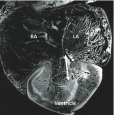 With a typical chelonian heart, leatherback turtles have considerable capacity for cardiac shunting. I always thought their high metabolism would be associated with pressure separation. But, the large heart may provide for high stroke volumes. DOI: 10.1111/joa.13670