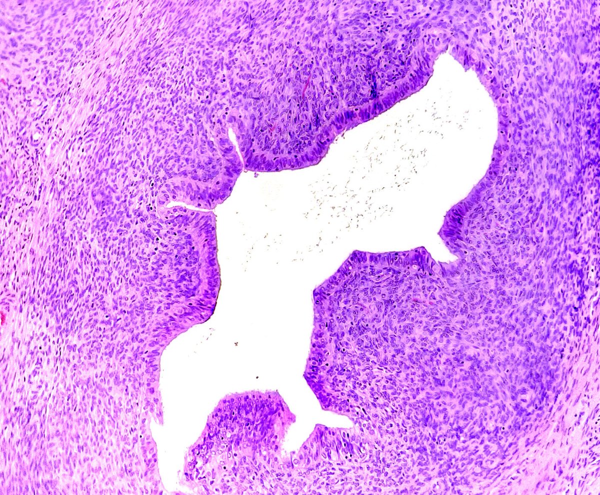 Quique_rs's tweet photo. Female, 27 yo with endometrial polyp▶️ adenosarcoma. 
✅Leaf-like (phyllodes-like) architecture. 
✅Stromal cytologic atypia. 
✅Periglandular stromal condensation. 
✅Rigid cystic dilatation. 

#gynpath https://t.co/zo9Tf2YvTm