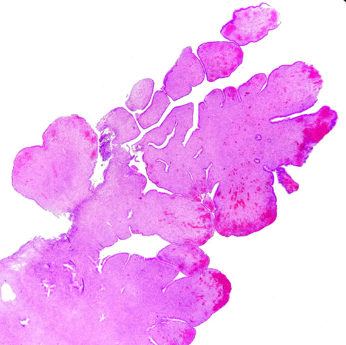 Quique_rs's tweet photo. Female, 27 yo with endometrial polyp▶️ adenosarcoma. 
✅Leaf-like (phyllodes-like) architecture. 
✅Stromal cytologic atypia. 
✅Periglandular stromal condensation. 
✅Rigid cystic dilatation. 

#gynpath https://t.co/zo9Tf2YvTm