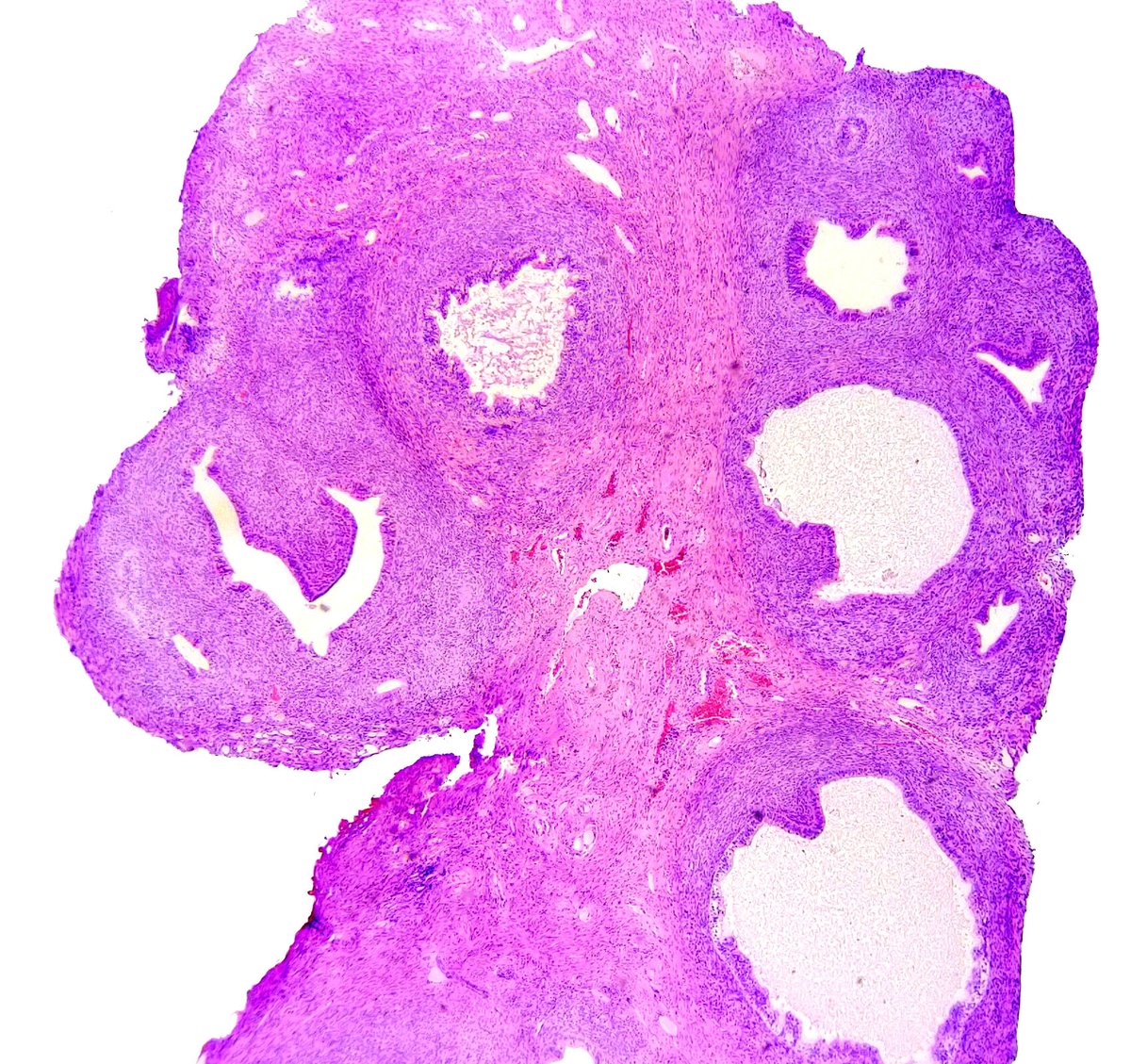 Quique_rs's tweet photo. Female, 27 yo with endometrial polyp▶️ adenosarcoma. 
✅Leaf-like (phyllodes-like) architecture. 
✅Stromal cytologic atypia. 
✅Periglandular stromal condensation. 
✅Rigid cystic dilatation. 

#gynpath https://t.co/zo9Tf2YvTm