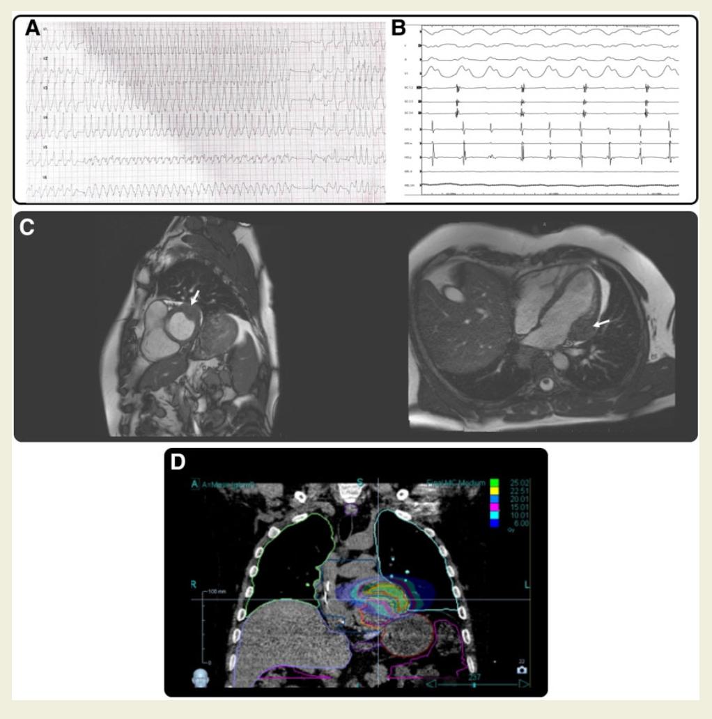 🔥 Check out this elegant case report published by Sandro Ninni and @BenjaminLongere from @CHU_Lille describing a young patient with VT related to a metastatic LV mass treated by stereotactic radioablation, CyberKnife
✅ no more VTs, no more AADs
#EPeeps #radiateVT