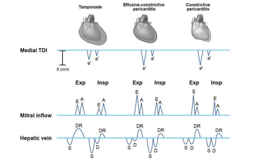 NephroPOCUS on Twitter "Mitral tissue Doppler, mitral inflow