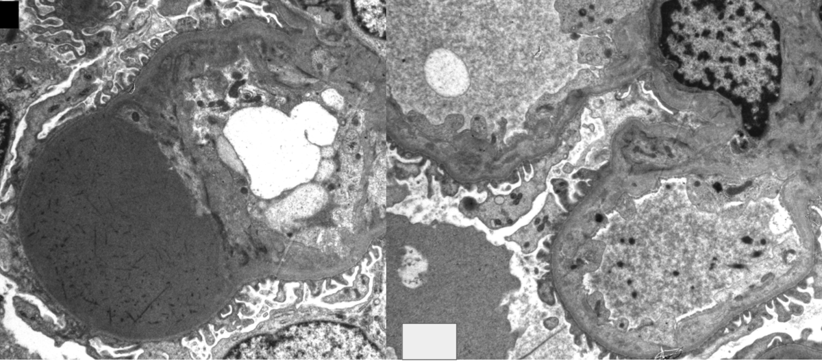 JZRenalPath's tweet photo. Slowly progressive subnephrotic proteinuria and several year history of everolimus + avastin therapy. Glomeruli with hyaline thrombi-like deposits + TMA features suggestive of VEGF inhibitor associated glomerulopathy.  #renalpath #onconephrology https://t.co/7p1ftKrDTJ https://t.co/SmX0a1drCf