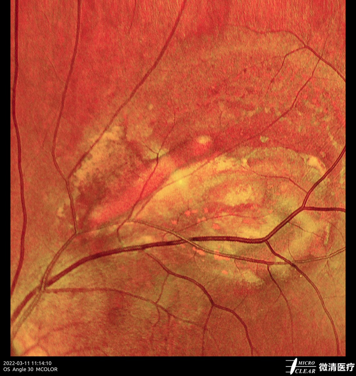 Microcleartec's tweet photo. #PathologicalMyopia &amp; #CNV
Pictured by Apollo, the #ConfocalRetinalOphthalmoscope
#autofluorescence #fluorescenceangiography #funduscamera #retinaldiseases #Oct #laserscanning https://t.co/FOlyaB9tuD