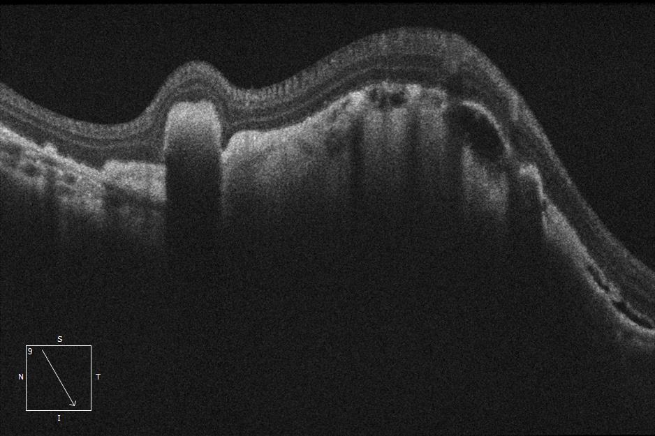 #PathologicalMyopia &amp; #CNV
Pictured by Apollo, the #ConfocalRetinalOphthalmoscope
#autofluorescence #fluorescenceangiography #funduscamera #retinaldiseases #Oct #laserscanning