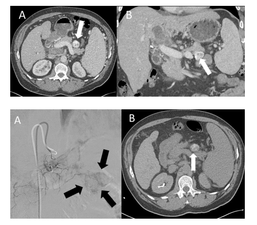 Percutaneous #Cryoablation of an Insulinoma in a Patient with Symptomatic #Hypoglycemia Refractory to Bland Microsphere #Embolization
link.springer.com/article/10.100…
#Letter
<a href="/BudLiddell/">Bud Liddell MD</a>