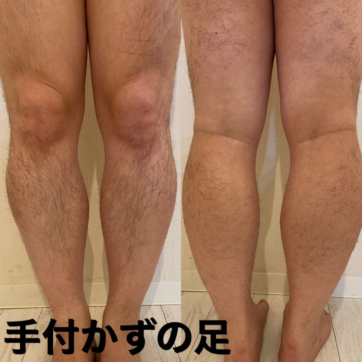fascinate_ryu's tweet photo. 6回施術後、1ヶ月放置した写真です。脱毛途中でも生えるスピードが遅くなるので、快適な状態で過ごせます！まだ、細い毛が生えてくることはありますが、メンテナンス程度で脱毛していくとその間隔も開いていきます。
両足(足の甲なし)1回
通常料金 10000円　sns割 8000円
お問合せお待ちしております！ https://t.co/fSHyjzXqYl