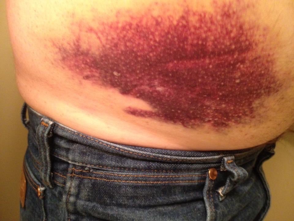 ⁦<a href="/DaveRickards/">Dave Rickards</a>⁩ ⁦<a href="/TheDSCshow/">The DSC Show</a>⁩  this happens to me just coughing.