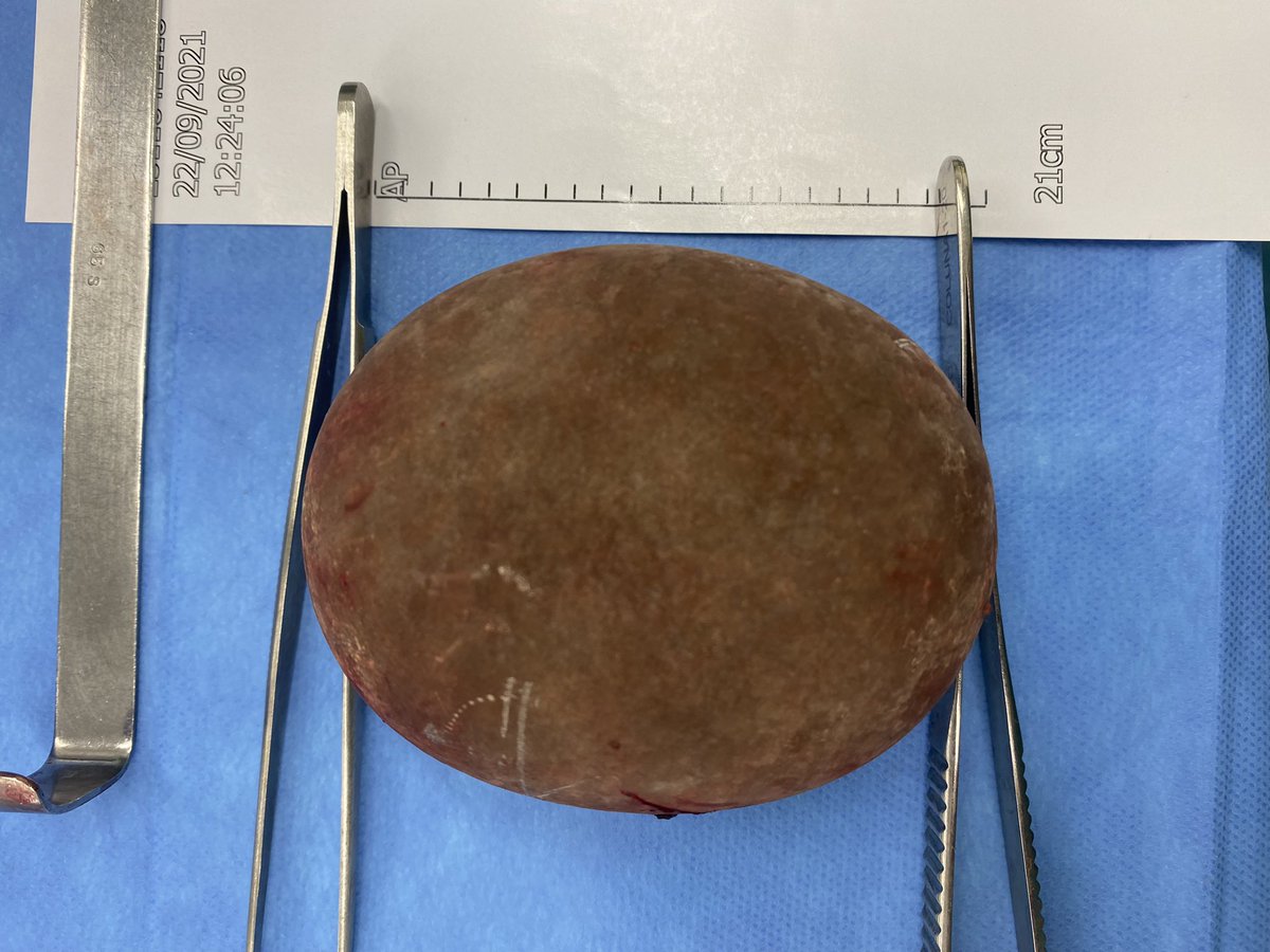 20 cm bladder stone! Has anyone ever seen bigger? #UroSoMe <a href="/AmerUrological/">Amer. Urol. Assn.</a> <a href="/Uroweb/">European Association of Urology (EAU)</a> <a href="/sbuoficial/">Sociedade Brasileira de Urologia</a> <a href="/so_uro/">UroSoMe</a>