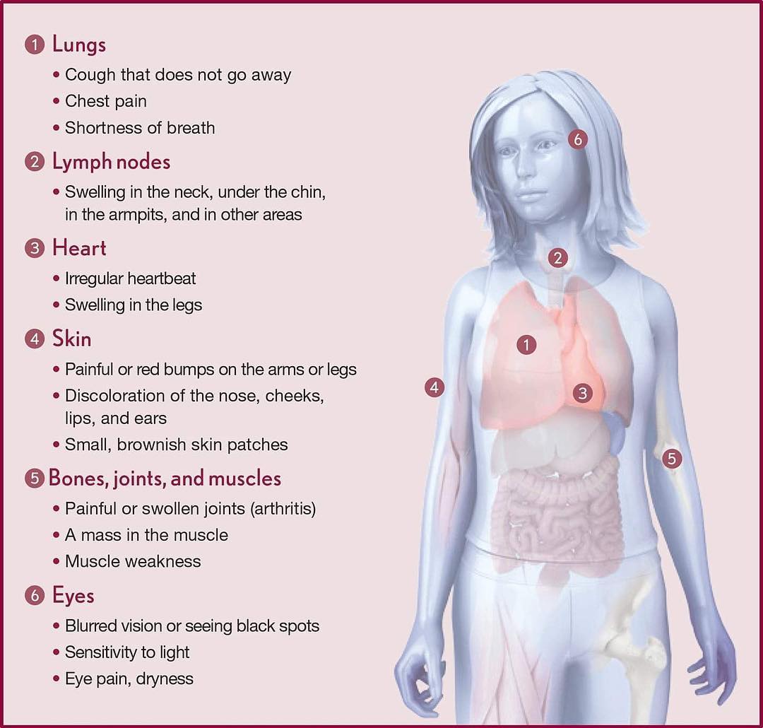 Sarcoidosis is often a systemic illness. 
💜FOLLOW US ON TWITTER!
x.com/sarcoidfilm

#chronicillness #sarcoidosis #invisibleillness  #SickNotWeak #Awareness #advocacy #raredisease  #documentary