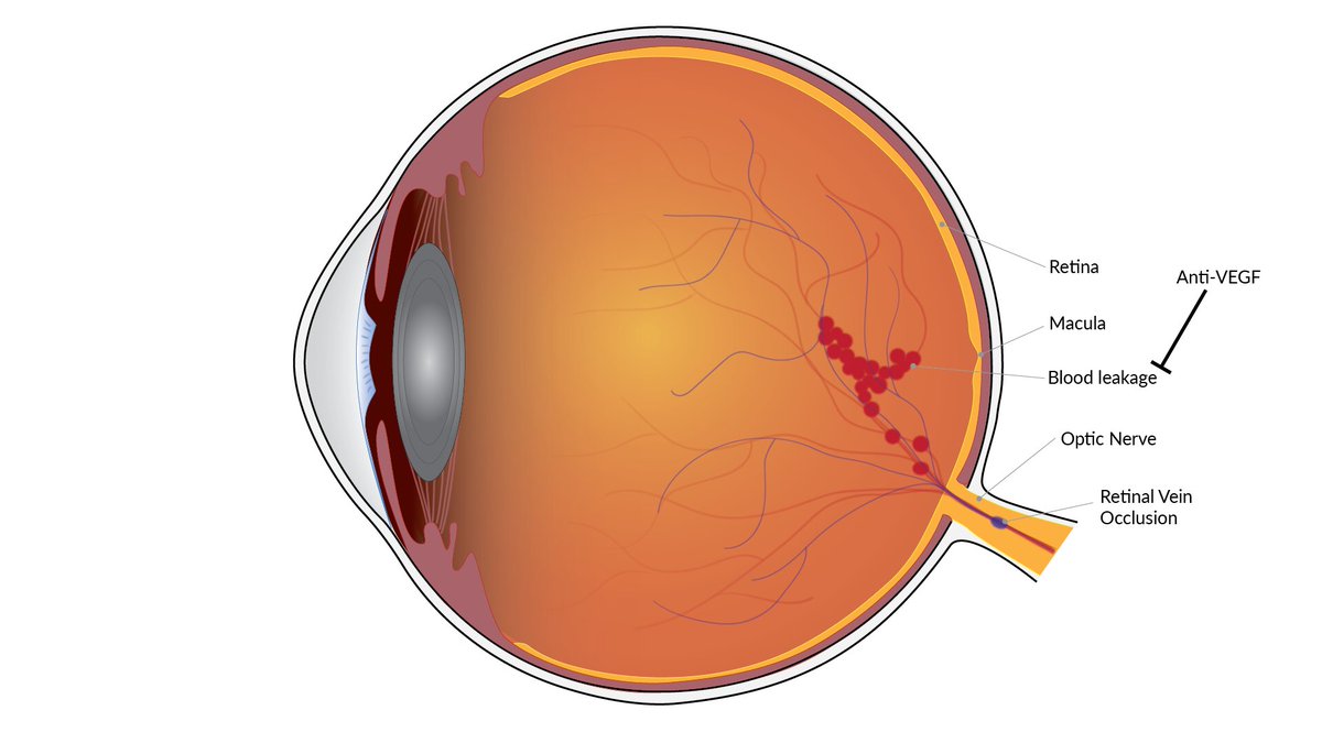 Ophthalmologyd8's tweet photo. Vision improvement is long-lasting with treatment for blinding blood vessel condition
Visit:https://t.co/MRE3gH4I2c
#Global #Ophthalmology 2022
May 04-05 2022 Prague, Czech Republic
#MVเจ้าอารมณ์ https://t.co/7LmSTMUaEe