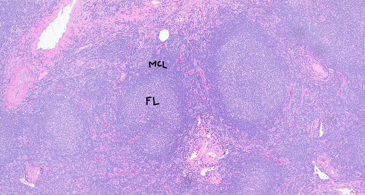 #never_stop_at_one_diagnosis: Low grade follicular lymphoma and coexisting subtle mantle cell lymphoma with a mantle zone growth pattern

Clues to pick it up⬇️

#hemepath #lymsm #pathtwitter #MedTwitter