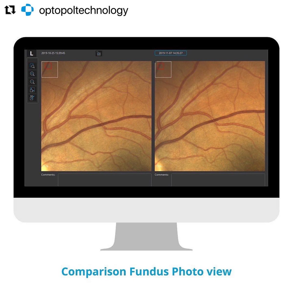 BiovisionHealth's tweet photo. What makes the REVO FC truly unique is its integrated non-mydriatic 12.3 Mpix Fundus Camera capable of capturing ultra-high quality and detailed color images. It is fully automated, safe and easy to use. 

#OCT #fundus #eyecare #innovation  #optopol #ophthalmology https://t.co/cTsjtOmYmx