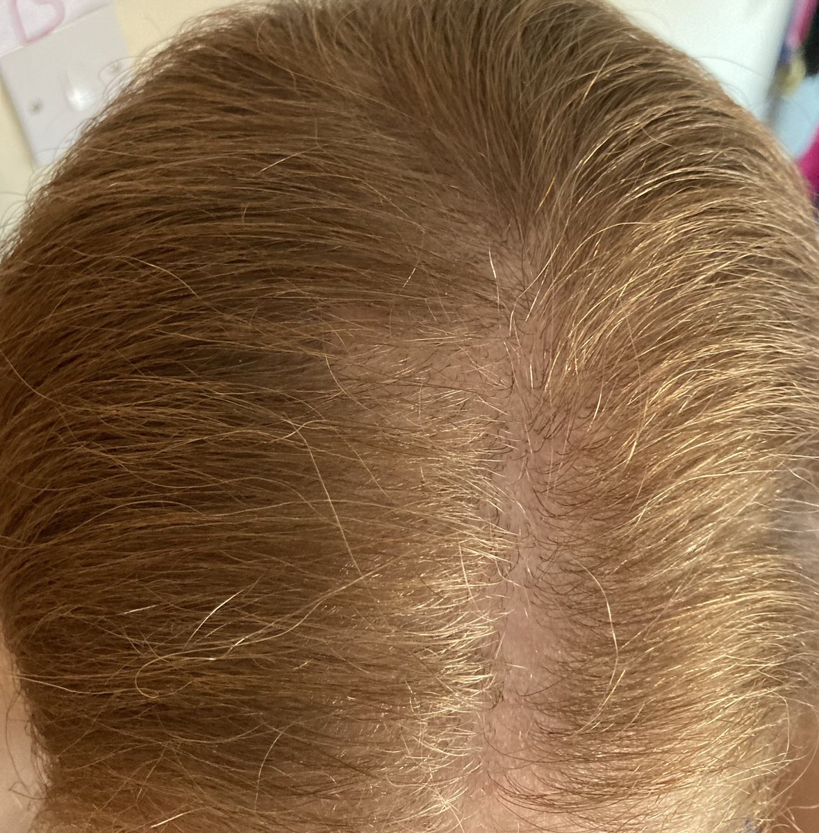 <a href="/GrowGorgeous/">Grow Gorgeous</a> I started using your Original Hair Serum and Repair Shampoo/ Conditioner after <a href="/NatsWoodward/">Natalie Woodward</a> recommended your products. 

A month later and a significant difference 😁
#cancerrecovery #ICUrecovery