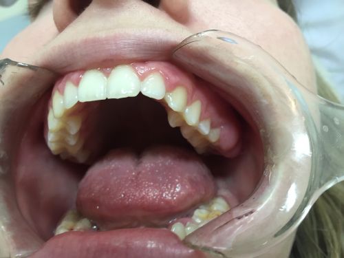 Healthonics's tweet image. Always eat a balanced diet! Like gut #bacteria, the bacteria (Good/Bad) present in our mouth can influence our overall health. Eating food rich in #sugar or refined carbohydrates can lead to poor oral health and, in turn, negatively affect our overall #health