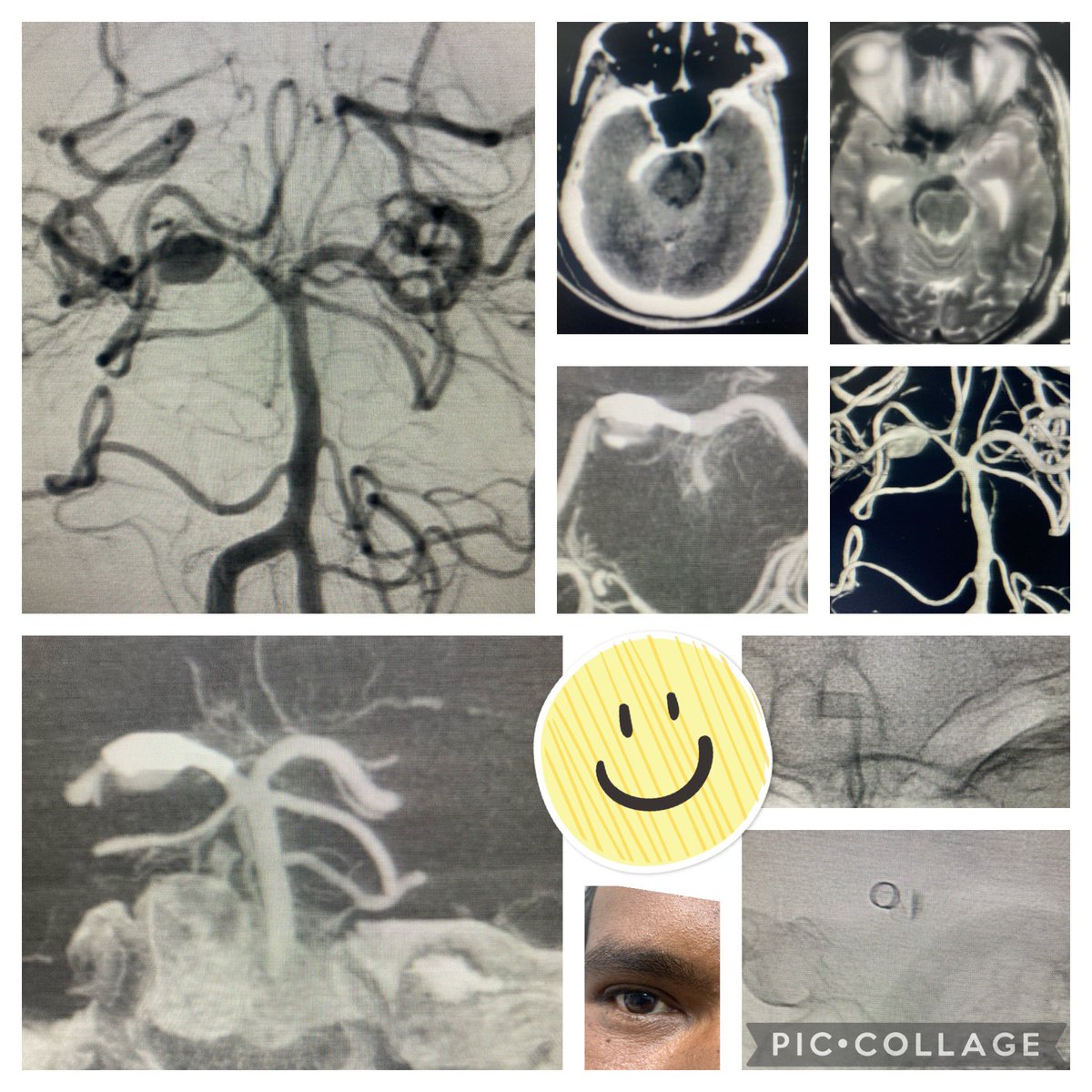 withoutscalpel's tweet photo. From 😜>>>>🤪
A case of 3rd nerve palsy rt pca aneurysm
Post flow diverter placement
Just look at his eye🥸🙆🏽♂️
#90daysfollowup @mheduNIMHANS #niir https://t.co/gI0DJDMJ4r