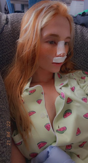 My cast comes off today 😍 https://t.co/sz3XBhep7x