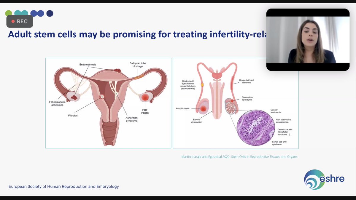 juanjo_fraire's tweet photo. Stem cells and the clinical promise 💪🏼💪🏼💪🏼⁦@SigStemCells⁩ ⁦@ESHRE⁩ #ESHREssentials https://t.co/yyN9J0vCEv