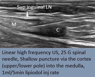 rakeshkvarma's tweet photo. Clinical Pearls in IR 11:
Successful cannulation of LN for INL @uab_ir means:
-Target the superficial inguinal LNs
-Opacification of efferent lymphatics
-Gradual LN staining with minimal leak
@SIRRFS @SIR_ECS @SIRspecialists @ISVIRIndia https://t.co/XTVs61s1q9