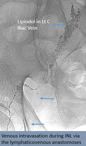 rakeshkvarma's tweet photo. Clinical Pearls in IR 11:
Successful cannulation of LN for INL @uab_ir means:
-Target the superficial inguinal LNs
-Opacification of efferent lymphatics
-Gradual LN staining with minimal leak
@SIRRFS @SIR_ECS @SIRspecialists @ISVIRIndia https://t.co/XTVs61s1q9