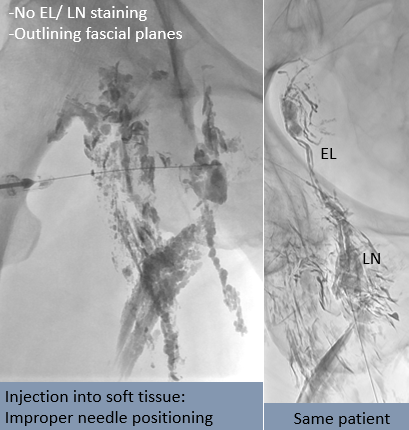 rakeshkvarma's tweet photo. Clinical Pearls in IR 11:
Successful cannulation of LN for INL @uab_ir means:
-Target the superficial inguinal LNs
-Opacification of efferent lymphatics
-Gradual LN staining with minimal leak
@SIRRFS @SIR_ECS @SIRspecialists @ISVIRIndia https://t.co/XTVs61s1q9