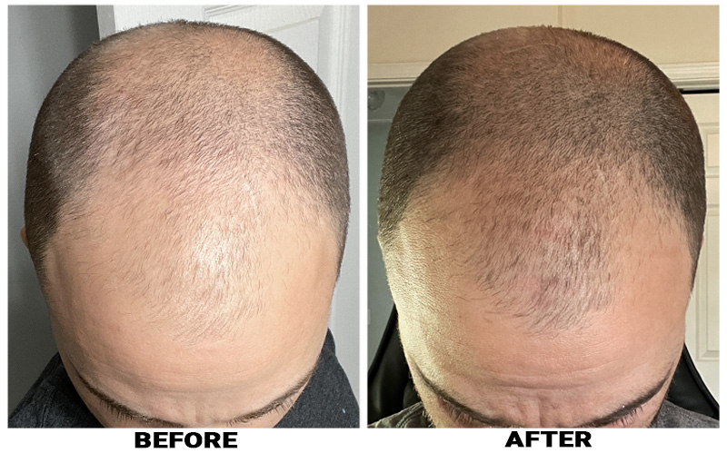 Share 140+ hair transplant first 10 days latest
