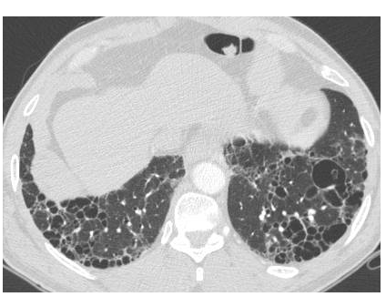 eduardomjfarina's tweet photo. Today's radiological case. What is your hypothesis?
#RadRes #FOAMrad #RadInTraining
@FelipeKitamura @radRounds @radsigns @UNIFESP_Rad https://t.co/7swvdg0350