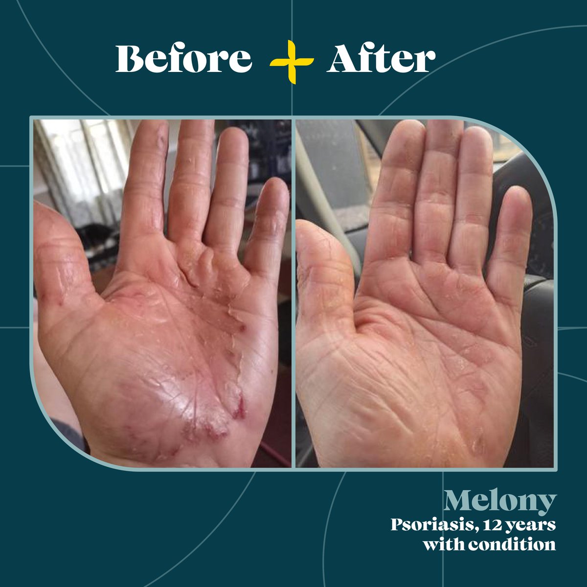bodewellskin's tweet photo. “I ordered the psoriasis cream and saw results in 12 hrs. I did have a minor outbreak after 2 weeks but it is under control now and didn't get as bad as the good days before this cream. It is wonderful to have human hands again and best thing is no prescription needed.” Melony https://t.co/Kej6RzXWQK
