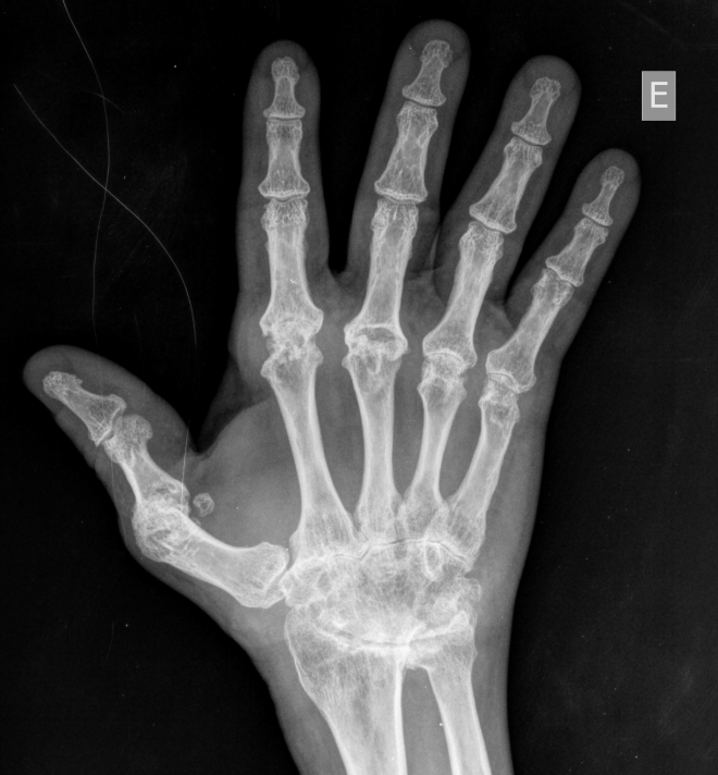 eduardomjfarina's tweet photo. Today's radiological case. What is your hypothesis?
#RadRes #FOAMrad #RadInTraining
@FelipeKitamura @radRounds @radsigns @UNIFESP_Rad https://t.co/7swvdg0350
