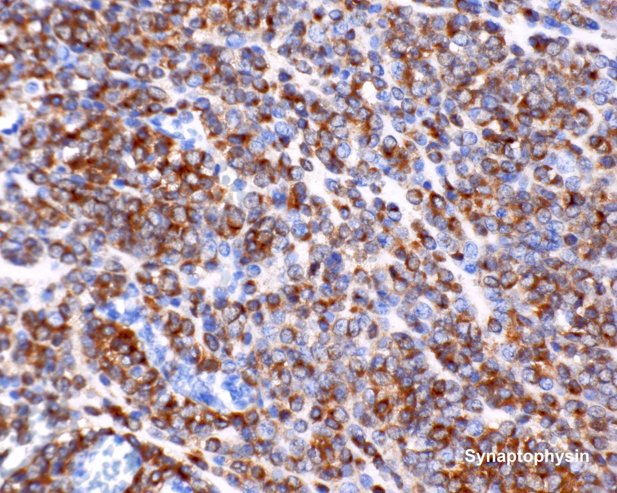 Gastric glomus tumor - don't be fooled by the synaptophysin.  They are negative for chromogranin and keratins.