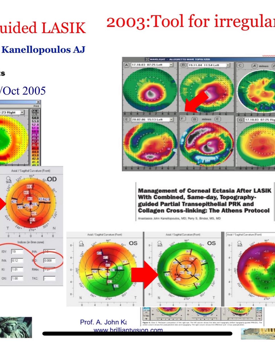 KanellopoulosMD's tweet photo. Our #CXL #keratoconus course at the #ASCRS https://t.co/XE6OrOa1aY recorded in it’s entirety. Tune in for 90’ of #cornealdiagnostics for KCN, #cxl techniques to include “our” #athensprotocol, outcomes, & complications-awesome collegue participation:”bestTalkinASCRS” remark ❤️ https://t.co/cSrIXksnF4