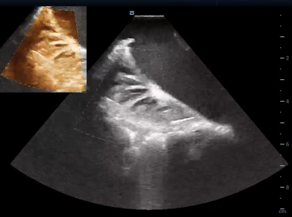 Clear visualization of the Crista Terminalis and adjacent pectinate muscle with intracardiac echo <a href="/Ashit_EPS/">Ashit Patel</a> <a href="/forkknifecab_EP/">Brock Gambill</a> #HDScope