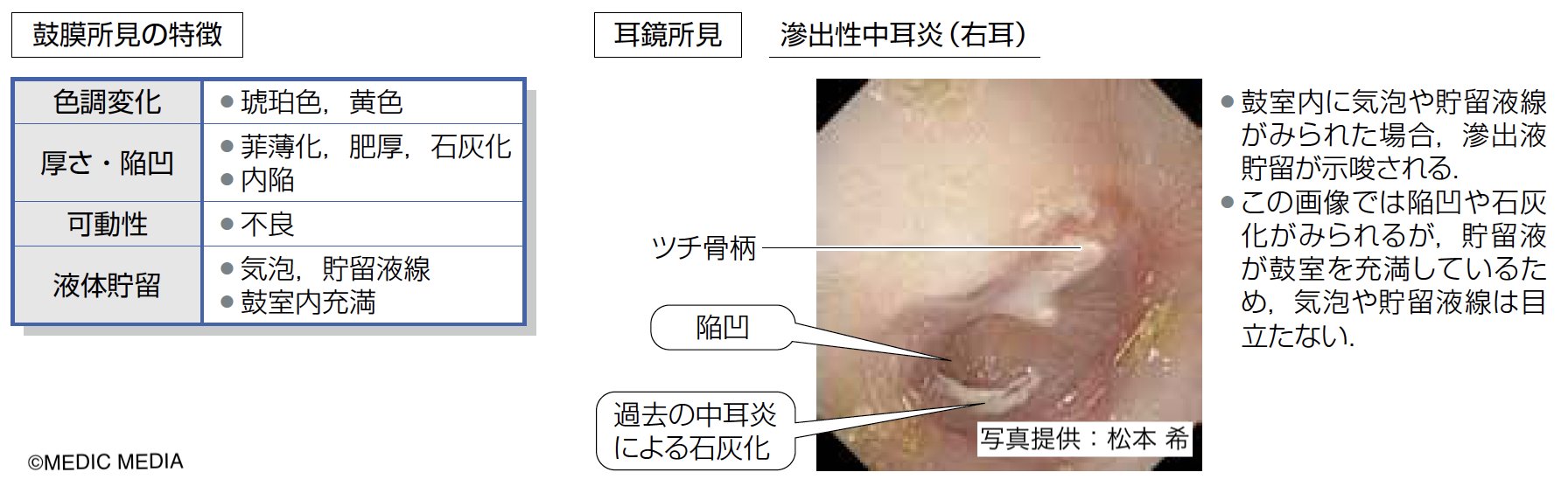 Ear popper イアーポッパー 中耳炎 滲出性中耳炎 病気がみえる Ear popper イアーポッパー 中耳炎 滲出性中耳炎 病気がみえる