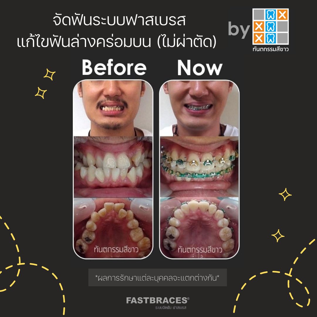 FastbracesAsia's tweet photo. ผู้ชายก็สามารถจัดฟันได้น้าา
หล่อขึ้นมากๆเลย ยิ้มแบบมั่นใจ
.
#จัดฟัน #จัดฟันเร็ว #รีวิวจัดฟัน #อิงฟ้าxระเบียบวาทะศิลป์ https://t.co/2XauB29zxS