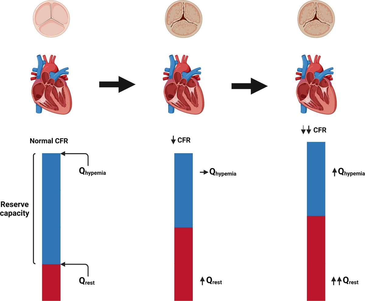 ThueOlsen's tweet photo. New paper on invasively determined #microcirculatory function in #AorticStenosis by Muhammad Sabbah from @Rigshospitalet with participation from us in cath lab @HerlevGentofte. @CopCard @HeartcentreC
#CoronaryPhysiology
https://t.co/5eiCXqpozi https://t.co/qsnZ7n7q5B