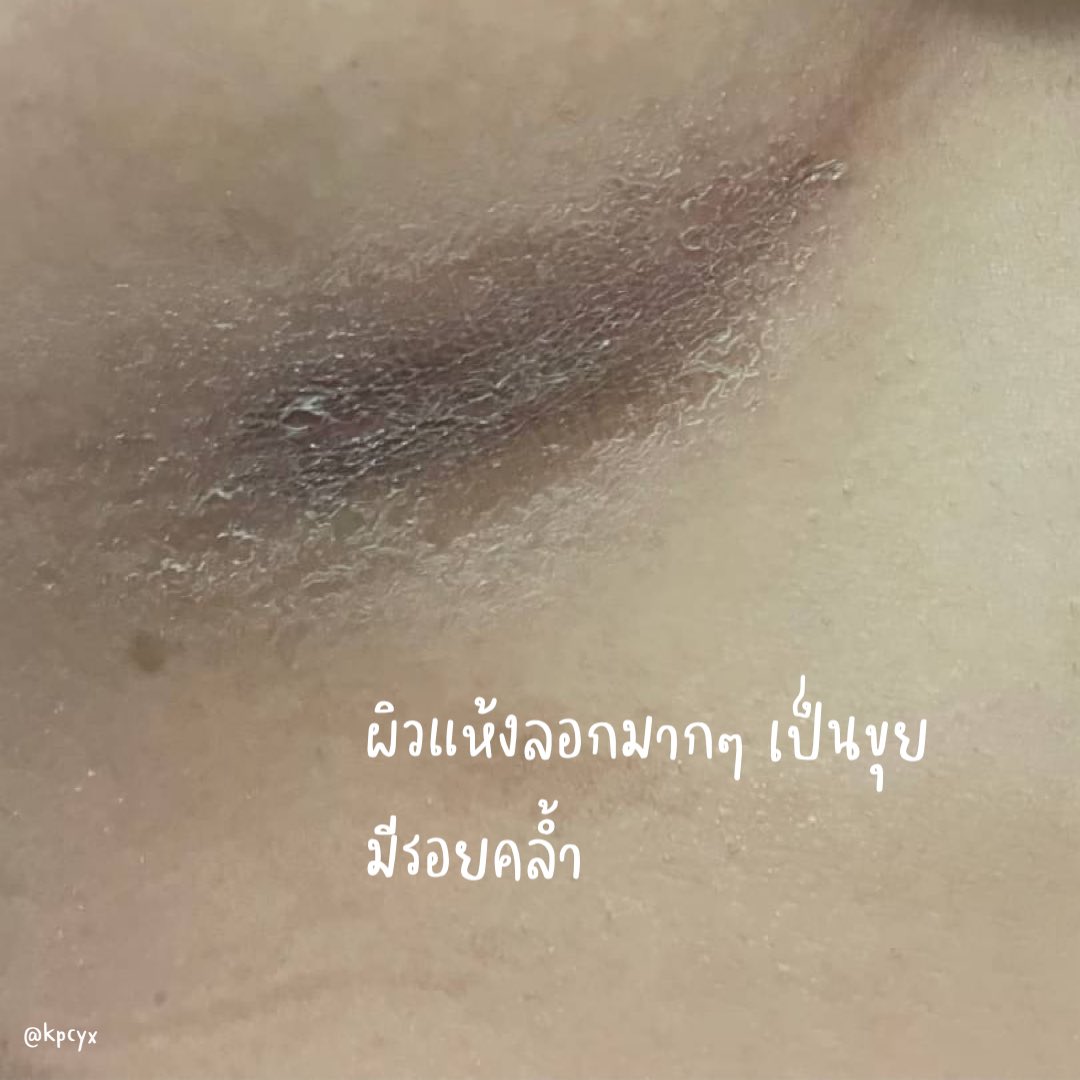 kpcyx's tweet photo. มารีวิวอาการที่ไม่น่าจะเป็น แต่เป็นเฉยเลย555 เราเป็น “ผื่นแพ้ชุดชั้นใน” ผิวใต้ราวนมแห้งจนเป็นขุย ลอกตกสะเก็ดเลยอะ เครียดมากๆ เลยลองใช้โลชั่นยูเรียของ eucerin ที่หมอผิวหนังแนะนำ แก 7 วัน ผิวกลับมาเป็นเหมือนเดิม y_y รอยคล้ำก็จางลงด้วย ดีใจจนจะร้องไห้ 😭🤟 
#ใช้ดีบอกต่อ https://t.co/t8I6aQ7CV2